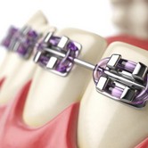 Cheap Braces in Tijuana