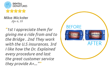 dental implants tijuana reviews